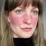Here knows how you can get rid of rosacea by using these skin-friendly ingredients.
