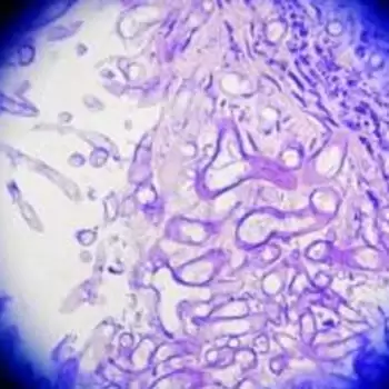 First reported case of black fungus in children in the country