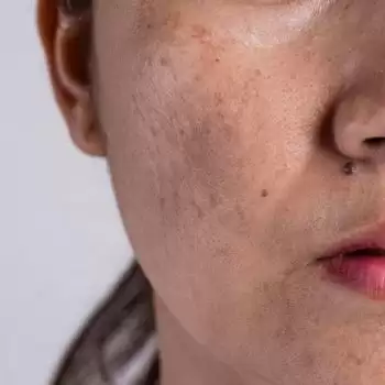 Get rid of brown spots on your face with these simple tips.
