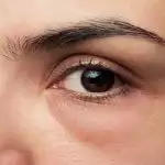 Try these remedies to reduce Puffy eyes.