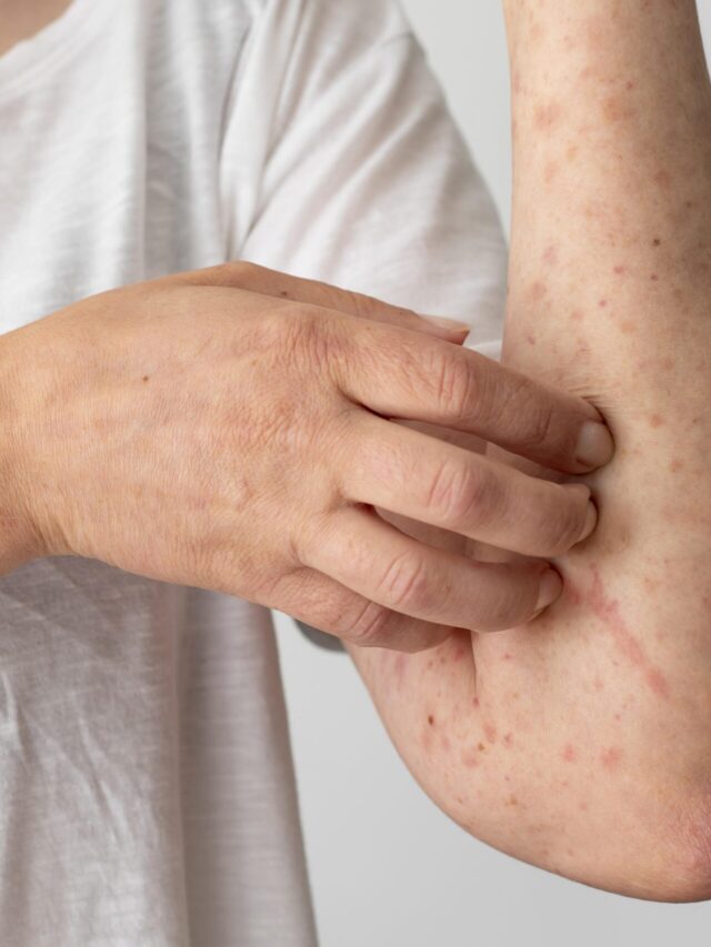 Home Remedies For Fungal Infection Buziness Bytes